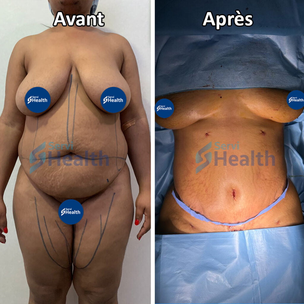Abdominoplastie Tunisie
