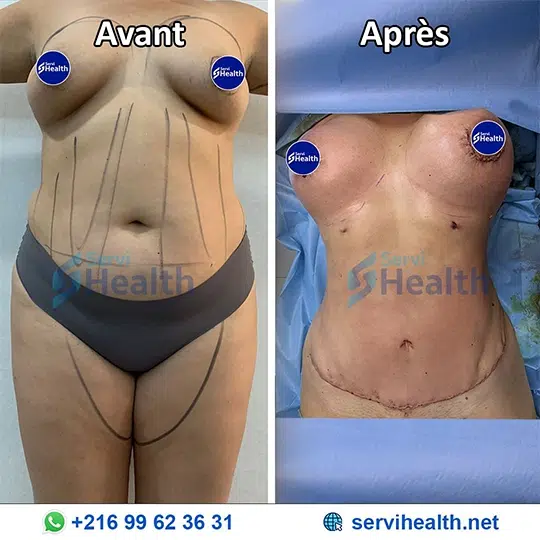 Abdominoplastie en Tunisie