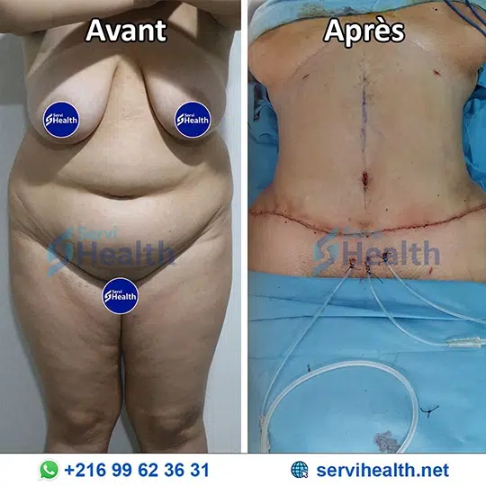 Abdominoplastie en Tunisie