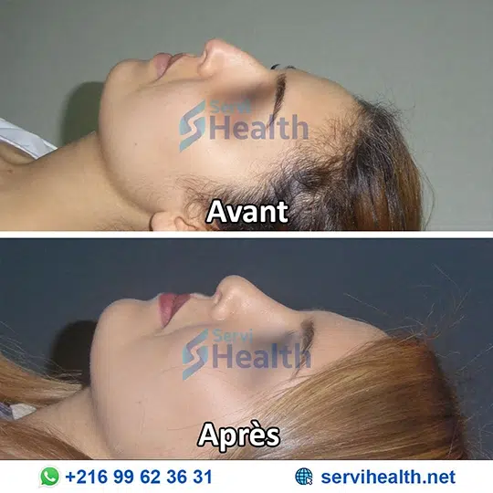 Rhinoplastie en Tunisie