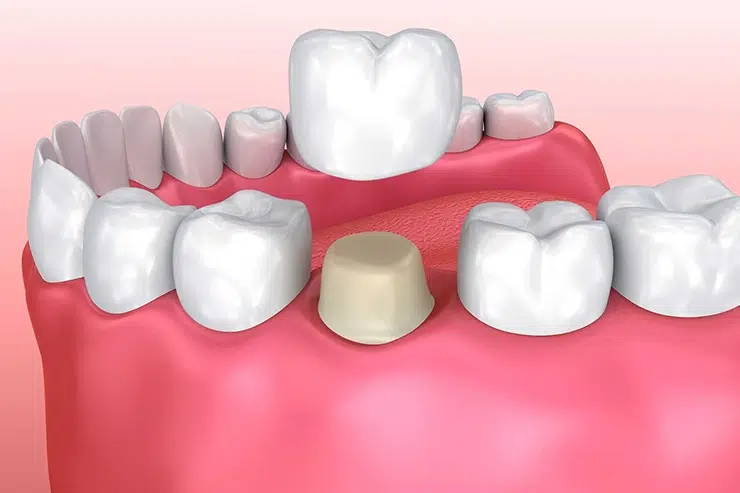 Couronnes Dentaires en Tunisie
