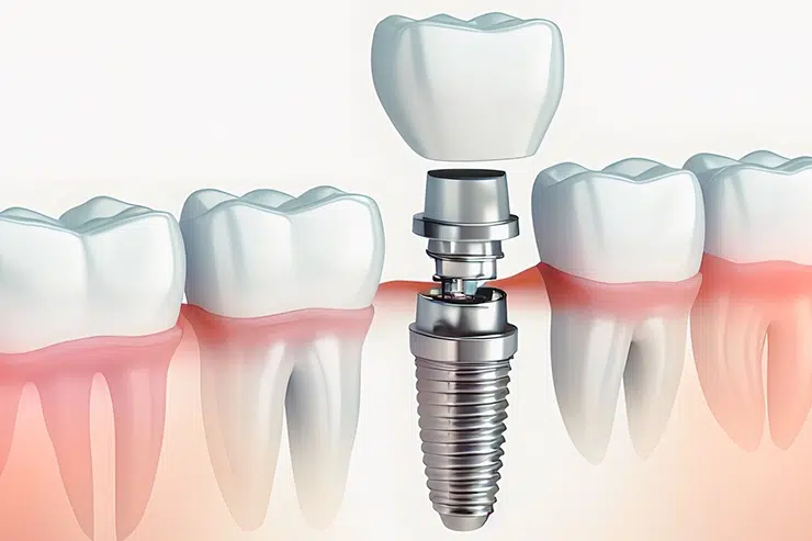 Implants Dentaires en Tunisie