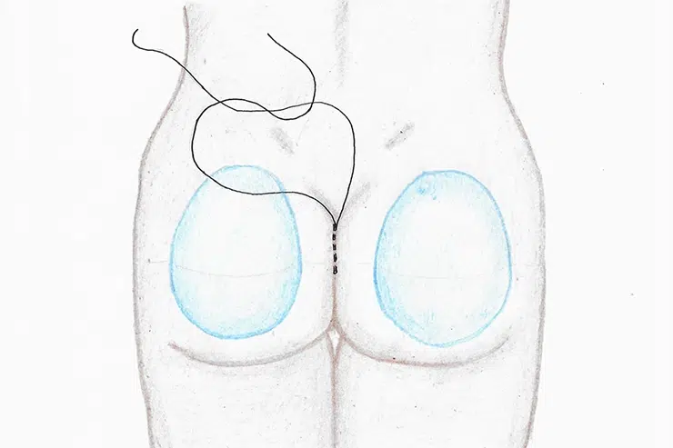 Augmentation Des Fesses en Tunisie