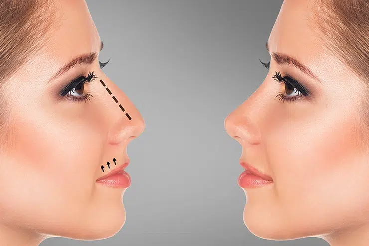 Rhinoplastie en Tunisie