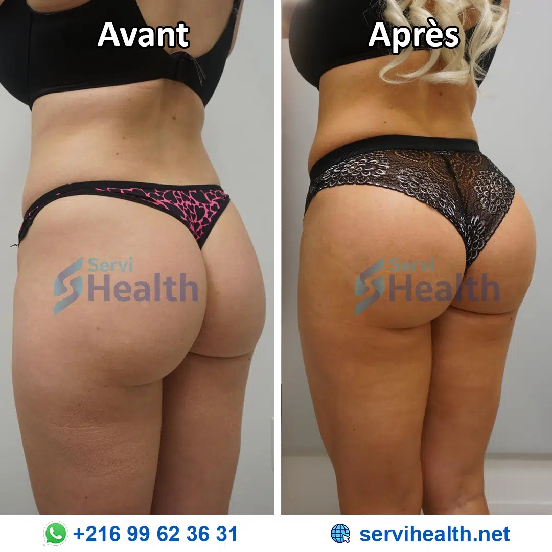 Augmentation Des Fesses en Tunisie